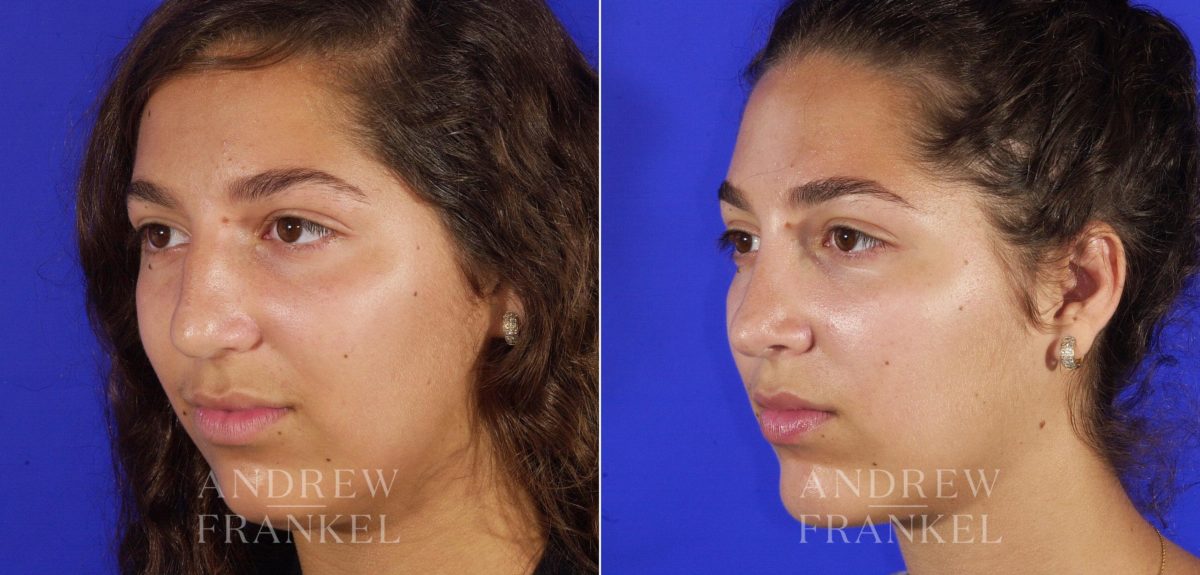 Rhinoplasty before and after photos in Beverly Hills, CA, Patient 5269