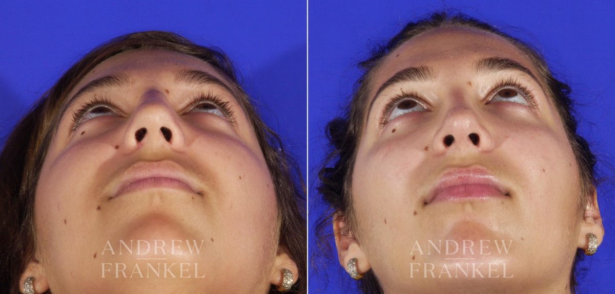 Rhinoplasty before and after photos in Beverly Hills, CA, Patient 5269