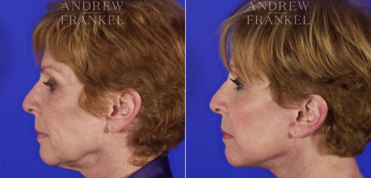 Facelift before and after photos in Beverly Hills, CA, Patient 5292
