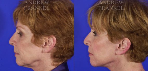 Facelift before and after photos in Beverly Hills, CA, Patient 5292