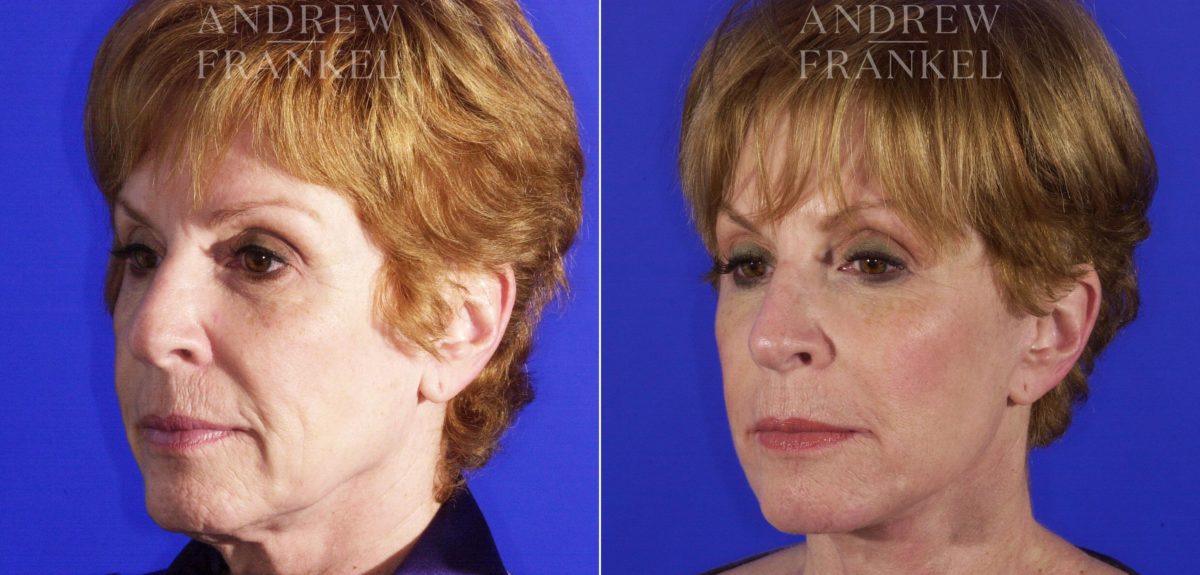 Facelift before and after photos in Beverly Hills, CA, Patient 5292