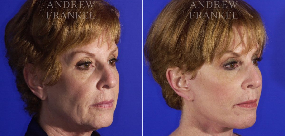 Facelift before and after photos in Beverly Hills, CA, Patient 5292