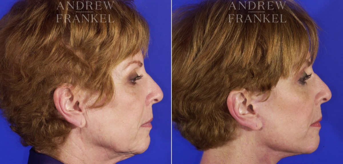 Facelift before and after photos in Beverly Hills, CA, Patient 5292