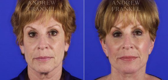 Facelift before and after photos in Beverly Hills, CA, Patient 5292