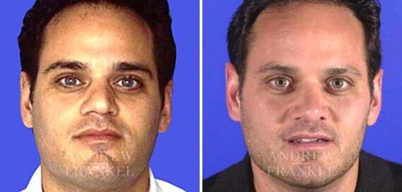 Rhinoplasty before and after photos in Beverly Hills, CA, Patient 5305