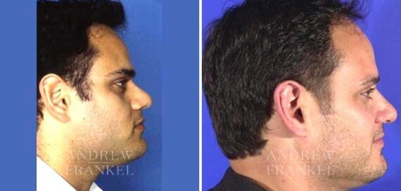 Rhinoplasty before and after photos in Beverly Hills, CA, Patient 5305