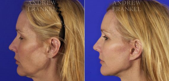 Facelift before and after photos in Beverly Hills, CA, Patient 5332