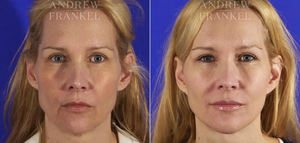 Facelift before and after photos in Beverly Hills, CA, Patient 5332