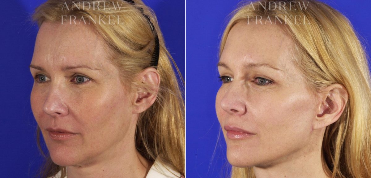 Facelift before and after photos in Beverly Hills, CA, Patient 5332