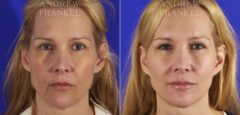 Facelift before and after photos in Beverly Hills, CA, Patient 5332
