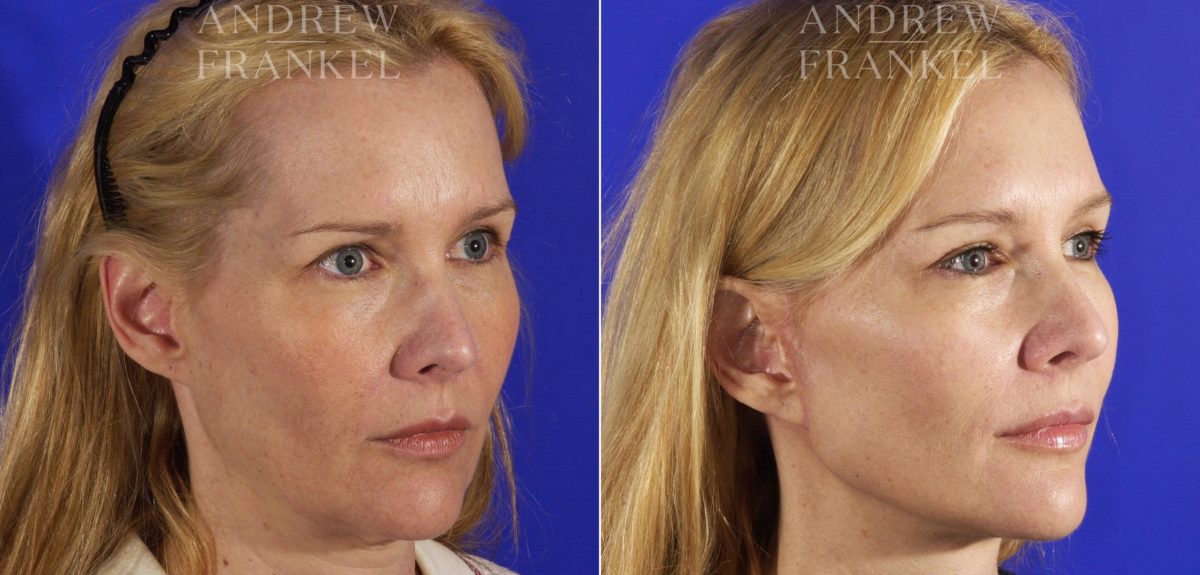 Facelift before and after photos in Beverly Hills, CA, Patient 5332