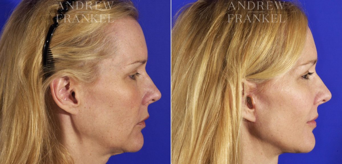 Facelift before and after photos in Beverly Hills, CA, Patient 5332