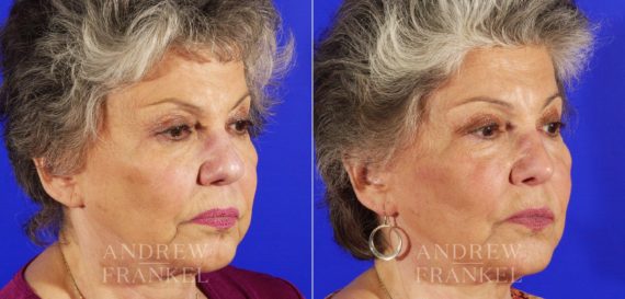 Rhinoplasty before and after photos in Beverly Hills, CA, Patient 5348