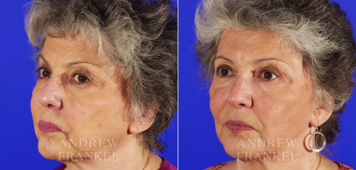 Rhinoplasty before and after photos in Beverly Hills, CA, Patient 5348