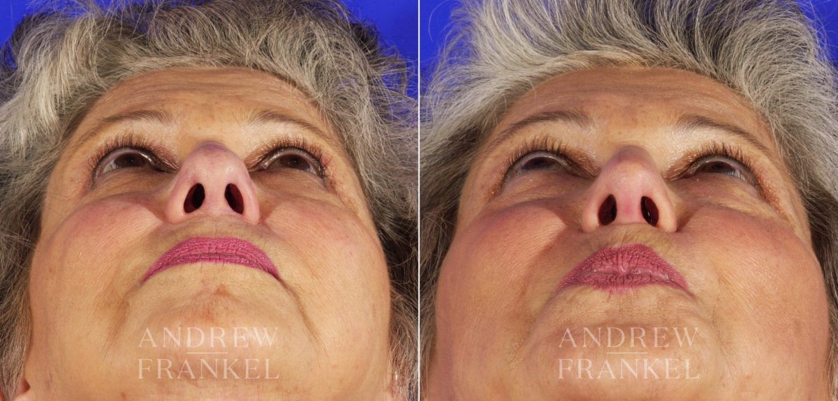 Rhinoplasty before and after photos in Beverly Hills, CA, Patient 5348
