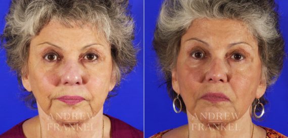 Rhinoplasty before and after photos in Beverly Hills, CA, Patient 5348