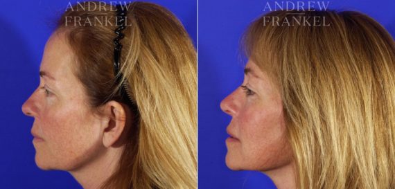 Facelift before and after photos in Beverly Hills, CA, Patient 5377