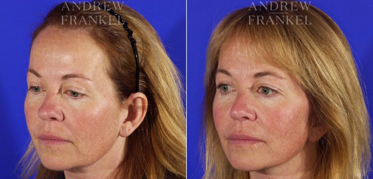 Facelift before and after photos in Beverly Hills, CA, Patient 5377