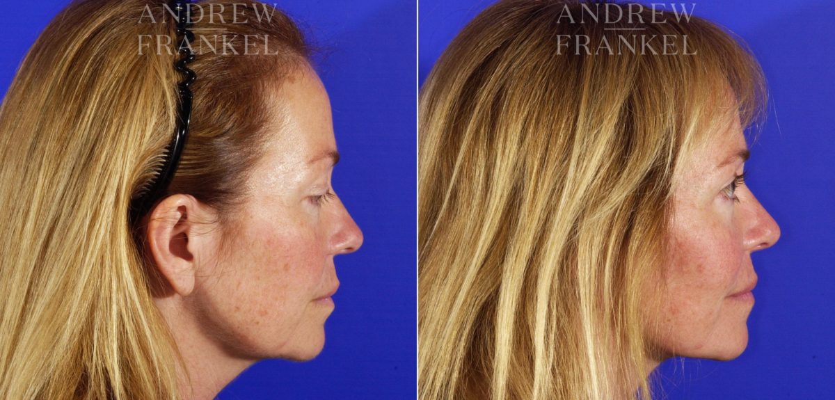 Facelift before and after photos in Beverly Hills, CA, Patient 5377