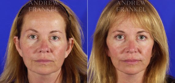 Facelift before and after photos in Beverly Hills, CA, Patient 5377