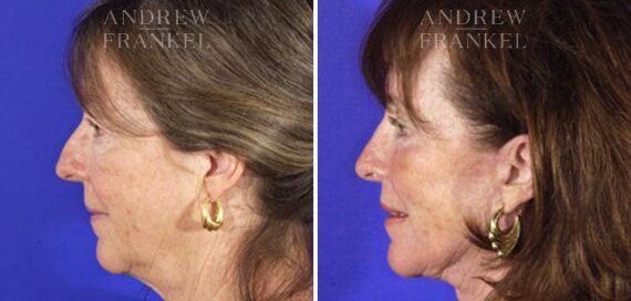 Facelift before and after photos in Beverly Hills, CA, Patient 5388