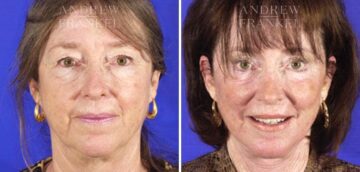 Facelift before and after photos in Beverly Hills, CA, Patient 5388
