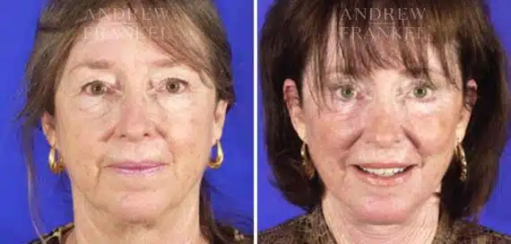 Facelift before and after photos in Beverly Hills, CA, Patient 5388