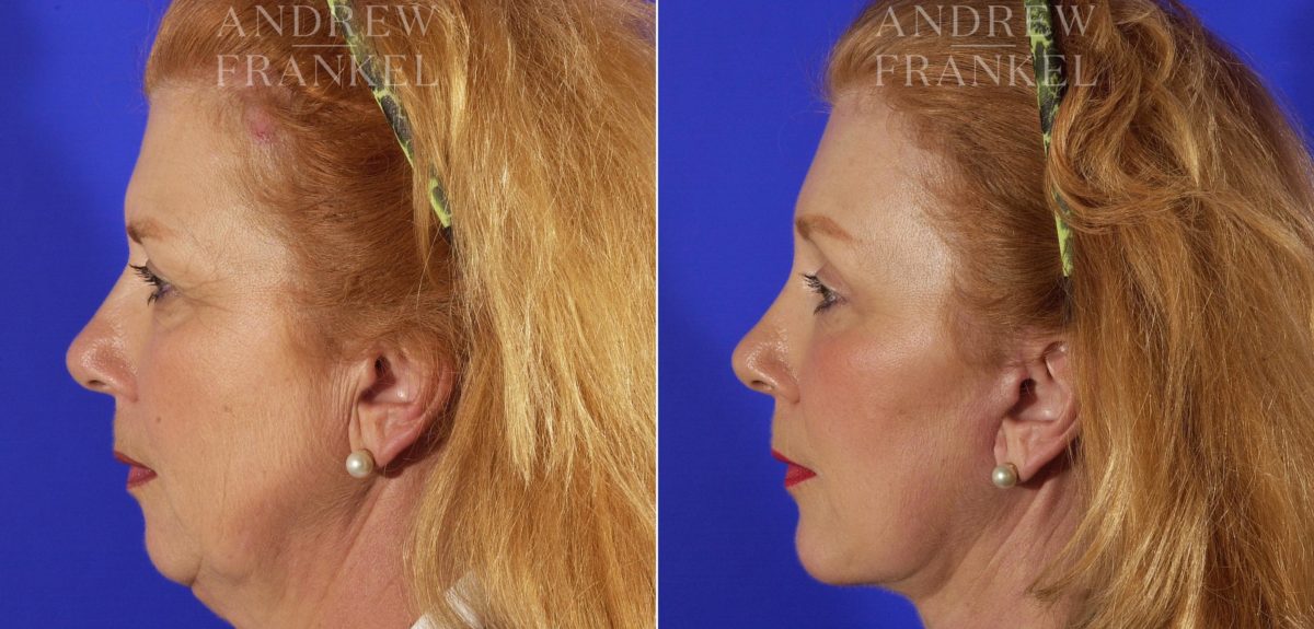 Facelift before and after photos in Beverly Hills, CA, Patient 5399