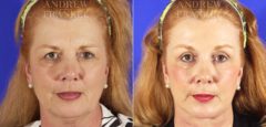 Facelift before and after photos in Beverly Hills, CA, Patient 5399