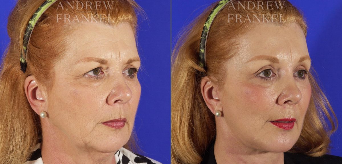 Facelift before and after photos in Beverly Hills, CA, Patient 5399