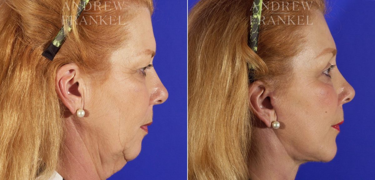 Facelift before and after photos in Beverly Hills, CA, Patient 5399