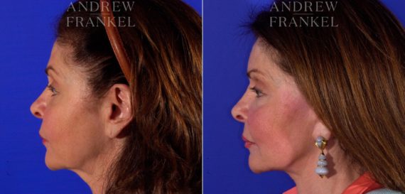 Facelift before and after photos in Beverly Hills, CA, Patient 5428