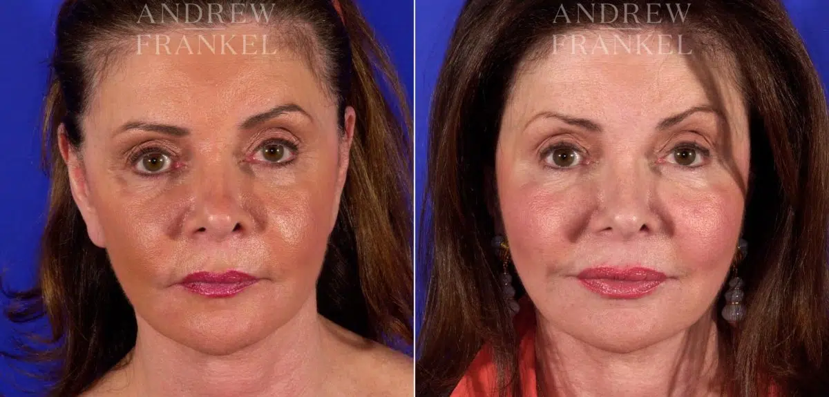 Facelift before and after photos in Beverly Hills, CA, Patient 5428