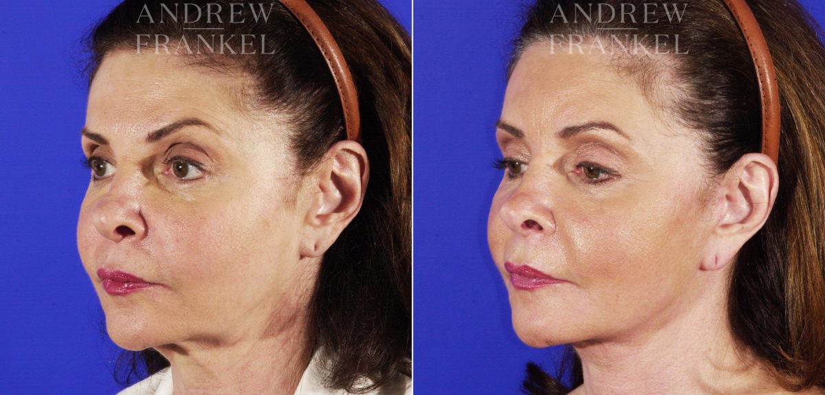 Facelift before and after photos in Beverly Hills, CA, Patient 5428
