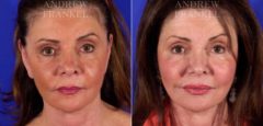Facelift before and after photos in Beverly Hills, CA, Patient 5428