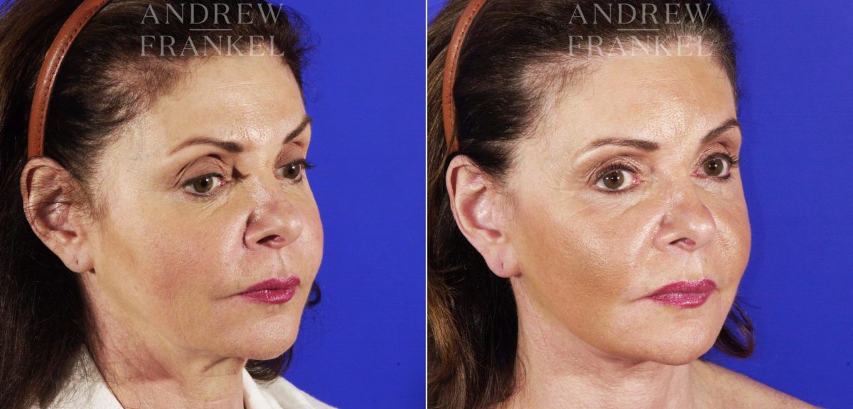 Facelift before and after photos in Beverly Hills, CA, Patient 5428