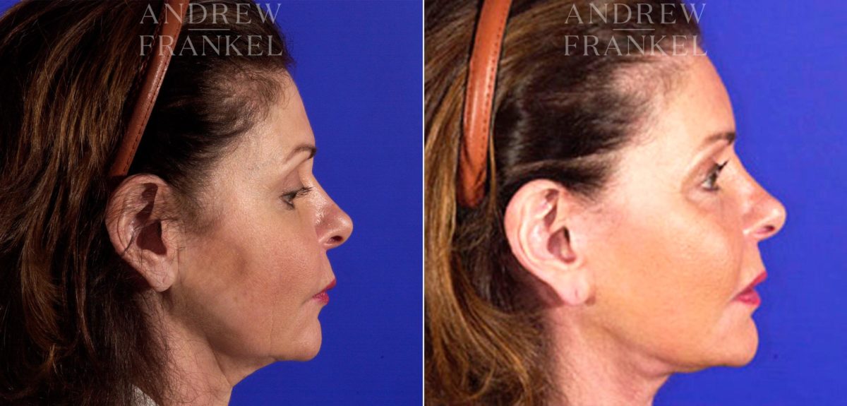 Facelift before and after photos in Beverly Hills, CA, Patient 5428