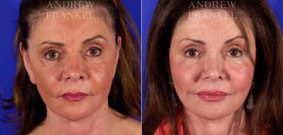 Facelift before and after photos in Beverly Hills, CA, Patient 5428