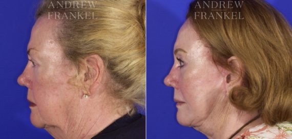 Facelift before and after photos in Beverly Hills, CA, Patient 5450