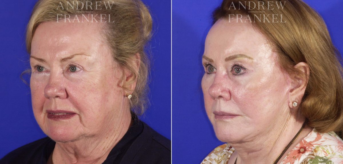 Facelift before and after photos in Beverly Hills, CA, Patient 5450