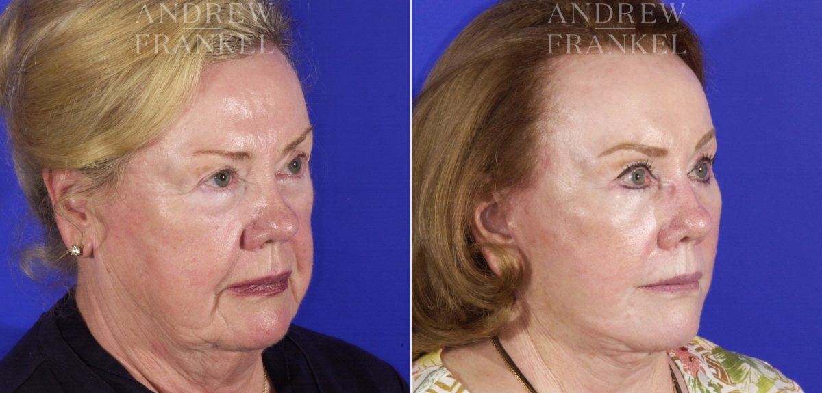 Facelift before and after photos in Beverly Hills, CA, Patient 5450