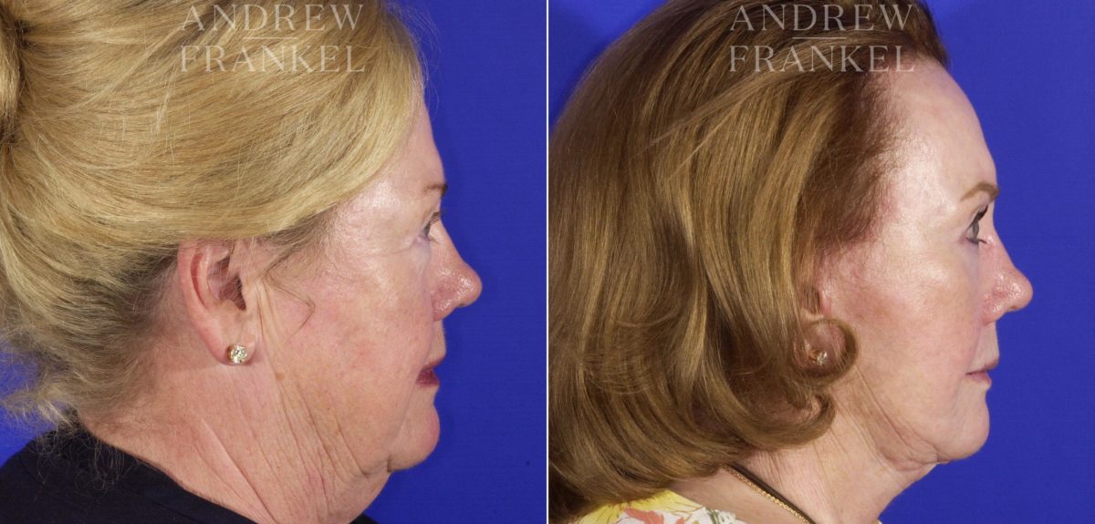 Facelift before and after photos in Beverly Hills, CA, Patient 5450