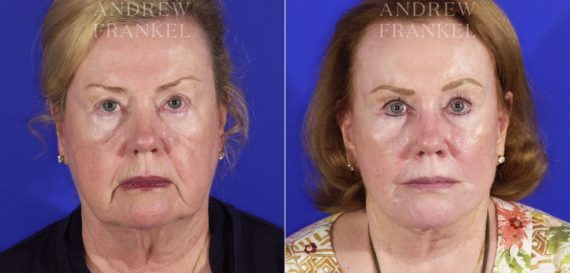 Facelift before and after photos in Beverly Hills, CA, Patient 5450