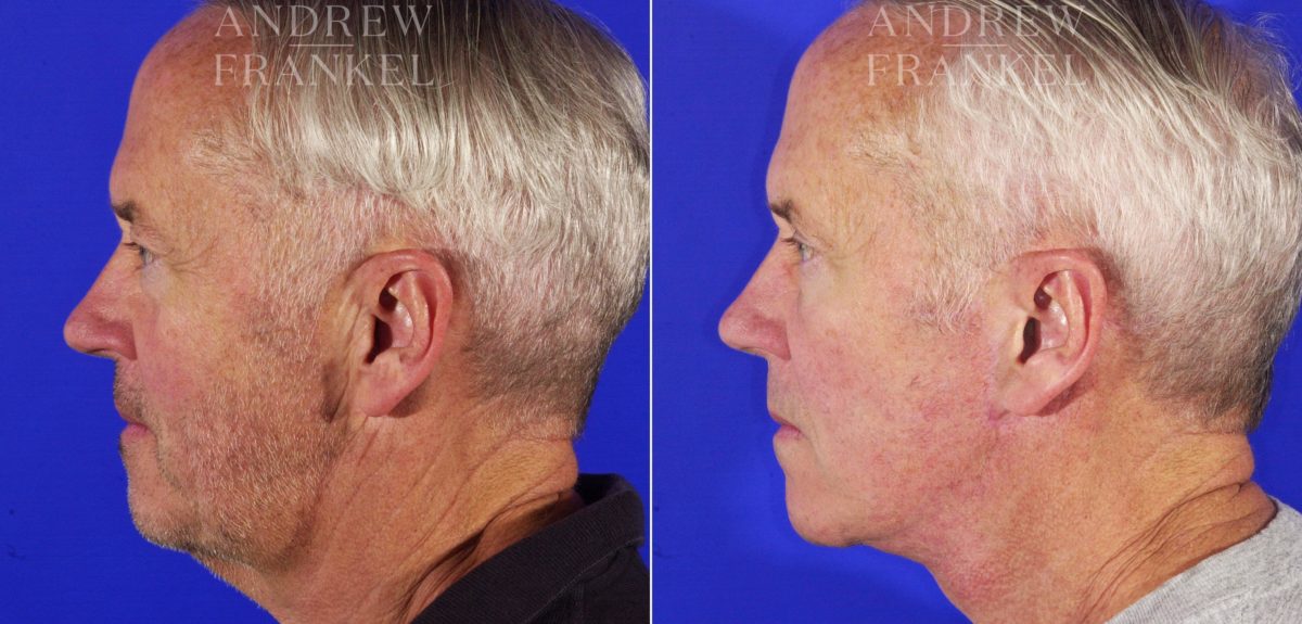 Facelift before and after photos in Beverly Hills, CA, Patient 5461