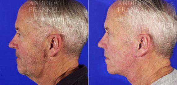 Facelift before and after photos in Beverly Hills, CA, Patient 5461
