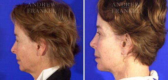 Facelift before and after photos in Beverly Hills, CA, Patient 5470