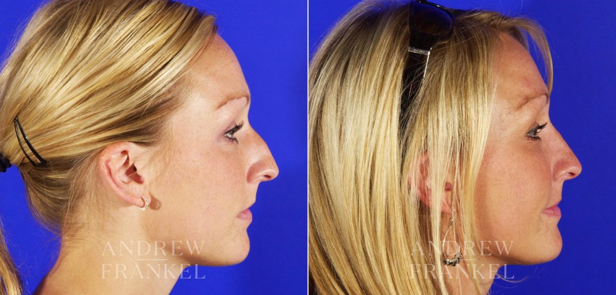 Rhinoplasty before and after photos in Beverly Hills, CA, Patient 5471