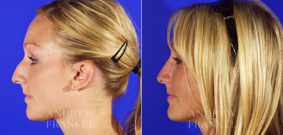 Rhinoplasty before and after photos in Beverly Hills, CA, Patient 5471