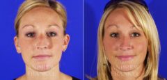 Rhinoplasty before and after photos in Beverly Hills, CA, Patient 5471