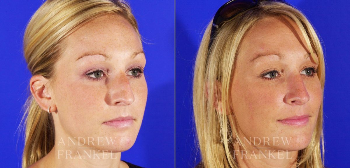 Rhinoplasty before and after photos in Beverly Hills, CA, Patient 5471